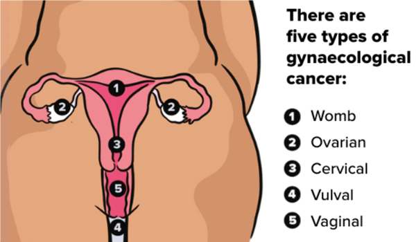 Gynae Cancer
