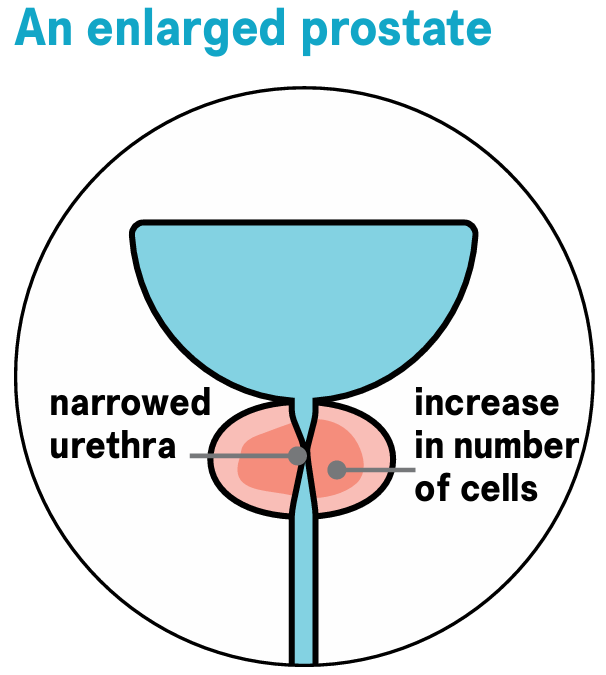 Enlarged prostate diagram